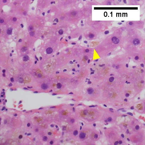 Bile in hepatocytes about central vein & in plugs in canaliculi [yellow arrowhead] (400X).