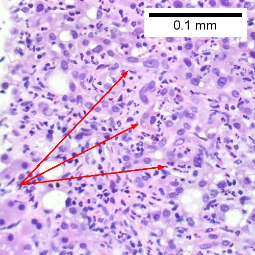 Proliferated bile ductules (arrows) bearing neutrophils within epithelium and lumens are features of obstruction that should prompt a search for interlobular ducts with acute inflammation (Row 2 Left 400X).