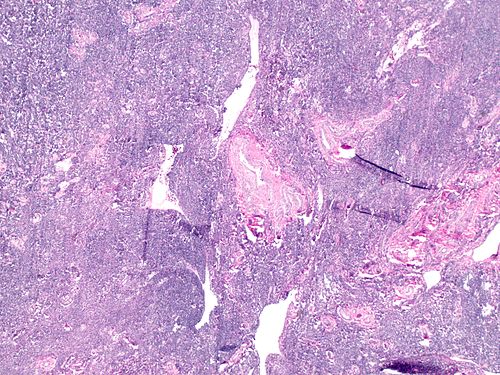 Highly cellular leiomyoma on showing thick walled vessels at 20x.jpg