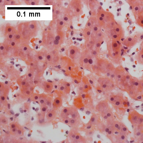 Necrotic hepatocytes in cords, presumably due to pressure (400X).