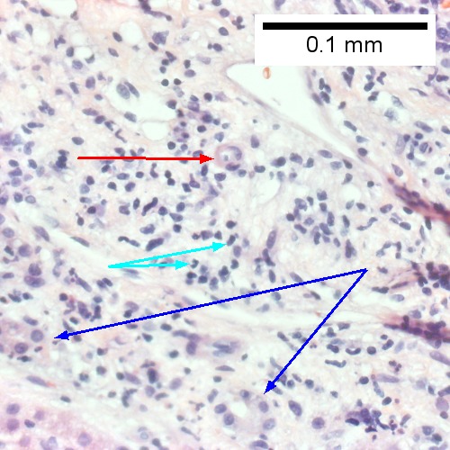 The epithelium of the ducts can be severely degenerated. Neutrophils (cyan arrows) invade epithelium of an interlobular duct that are recognizable mainly as a circle of rounded nuclei; the associated arteriole (red arrow) should be identified to ensure an interlobular duct is being evaluated. Note the proliferated bile ductules (blue arrows) (Row 2 Right 400X).