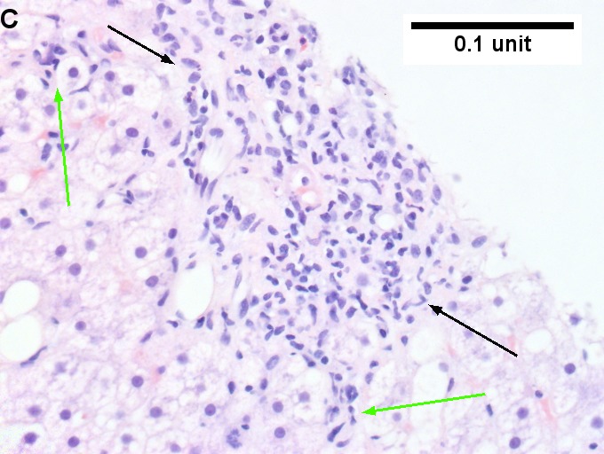 Changes of steatohepatitis and interface hepatitis, with granuloma. Patient with diabetes was ANA, AMA, HCV, HBV negative, without drugs known to produce granulomas or interface hepatitis. This may be a case of AMA negative primary biliary cirrhosis, but studies to determine that with certainty were not performed.