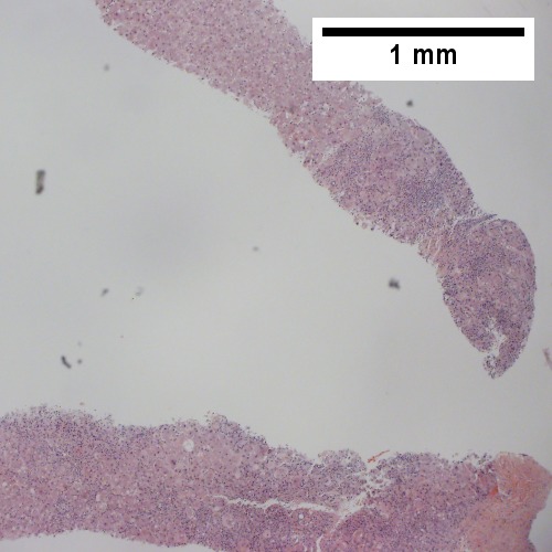 Inflamed & relatively unaffected segments (40X).