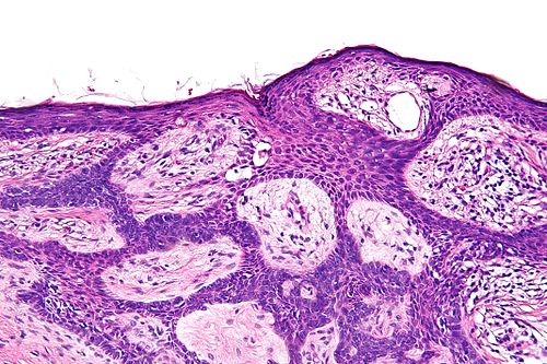 Basal cell carcinoma fibroepitheliomatous pattern - high mag.jpg