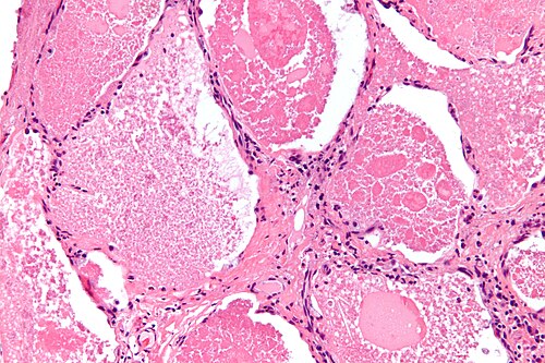 Pulmonary alveolar proteinosis -3- high mag.jpg