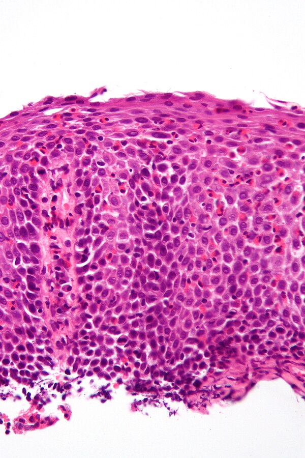 Eosinophilic Esophagitis Libre Pathology 6852