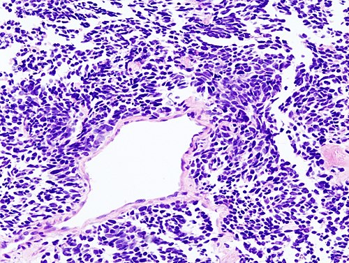 Lung small cell carcinoma (2) by core needle biopsy.jpg