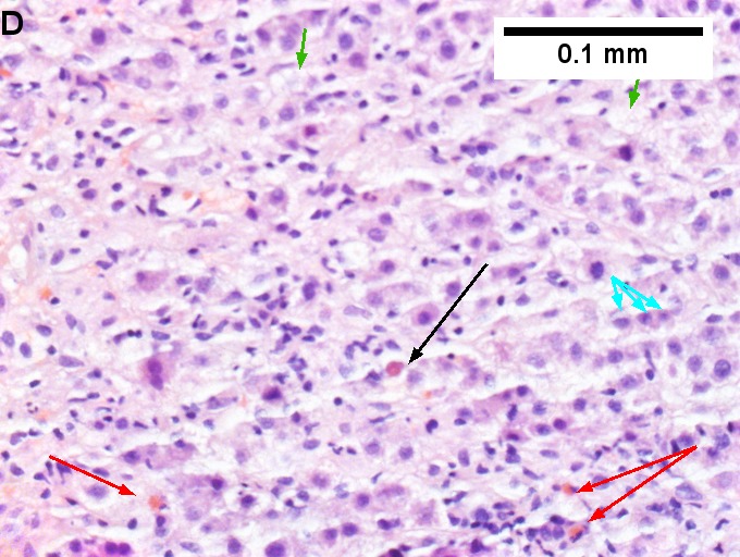 Drug induced liver injury in a young adult man