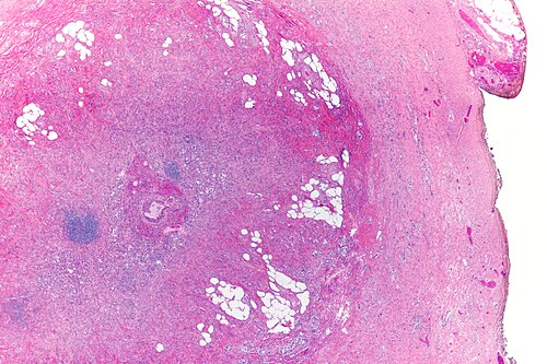Goblet cell carcinoid - very low mag.jpg