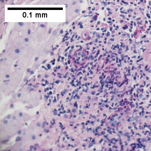 PAS with diastase showing neutrophil in bille duct lumen, diagnostic of acute cholangitis (400X).