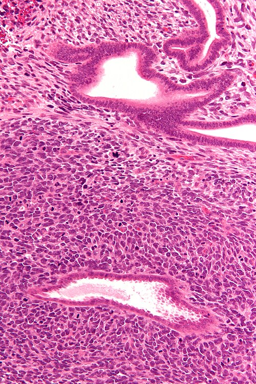 Uterine adenosarcoma - high mag.jpg