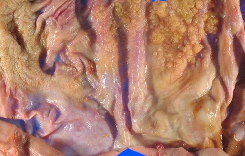 Gross of borderline serous tumor of the ovary 01.jpg