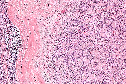 Intranodal palisaded myofibroblastoma - intermed mag.jpg
