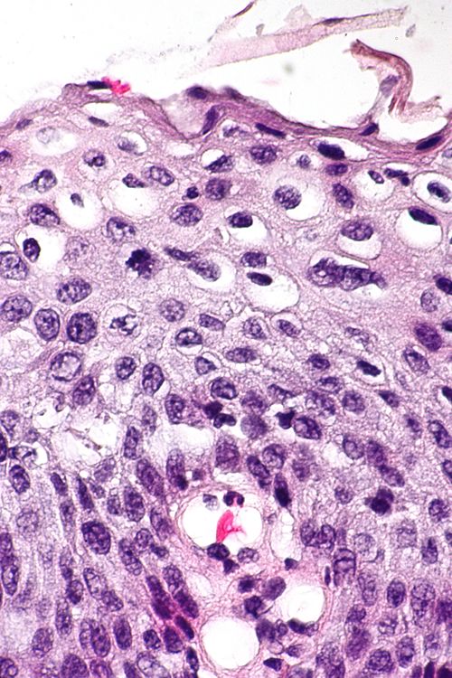 High grade squamous intraepithelial lesion - 2 -- very high mag.jpg