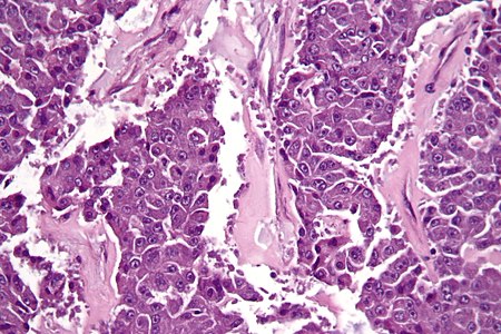 Acinar Cell Carcinoma Of The Pancreas Libre Pathology