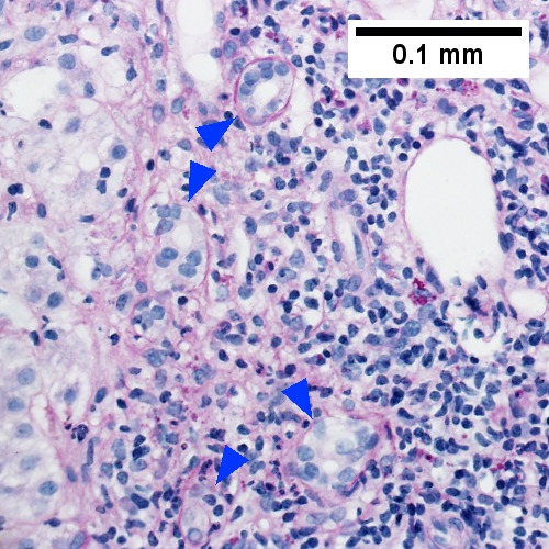 PAS with diastase stain shows proliferated bile ductules [blue arrowheads] in stroma with mixed inflammatory infiltrate (400X)