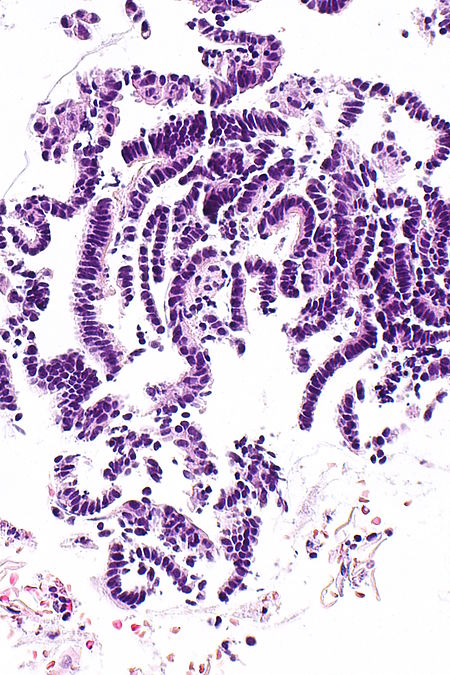 Atrophic Endometrium Libre Pathology 