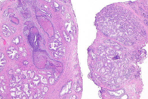 Adenosis of prostate -- very low mag.jpg