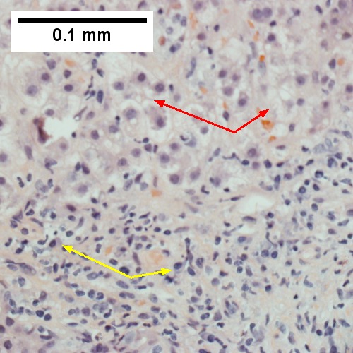 Interface hepatitis with plasma cells (yellow arrows) and ballooned hepatocytes (red arrows). Lobule is disorganized (400X).
