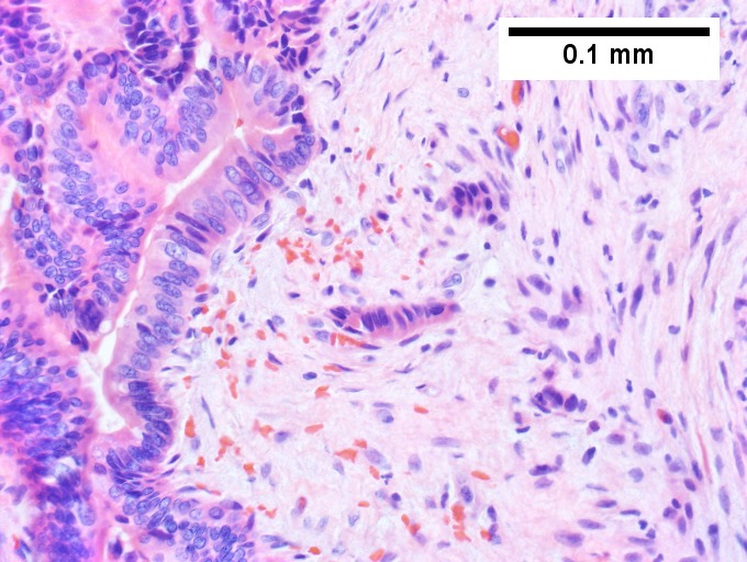 Intraductal papillary neoplasm of common bile duct with associated invasive carcinoma.