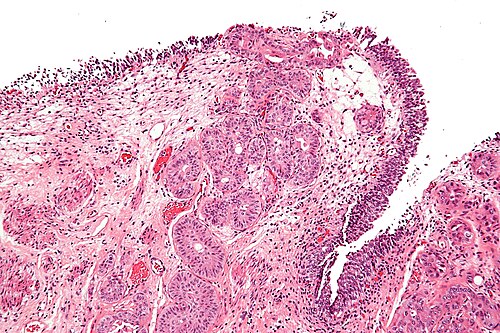 Nested variant of urothelial carcinoma - intermed mag.jpg