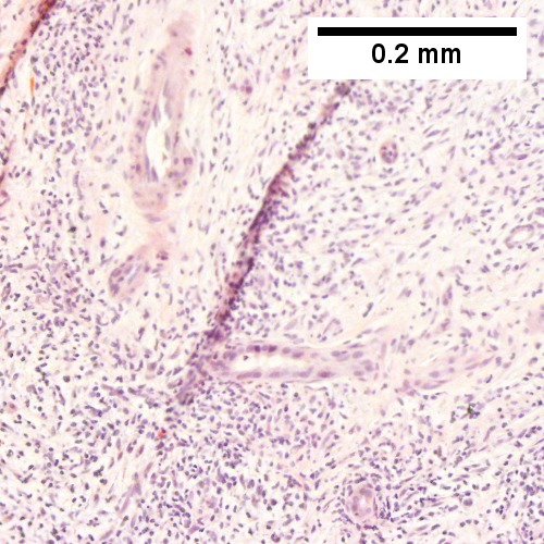 Apparent portal inflammation with unaffected interlobular bile duct (Row 2 Right 200X).