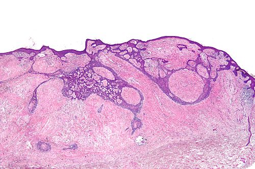 Basal cell carcinoma fibroepitheliomatous pattern - very low mag.jpg