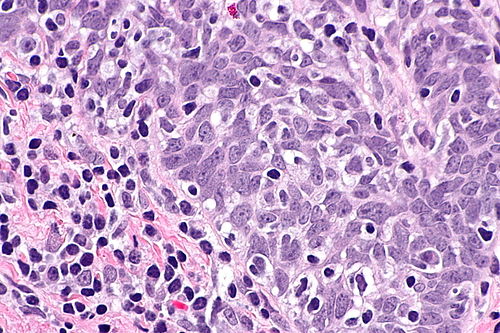 Squamous cell carcinoma - p16 positive -- very high mag.jpg