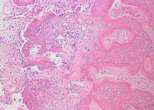 Bizarre parosteal osteochondromatous proliferation - Libre Pathology
