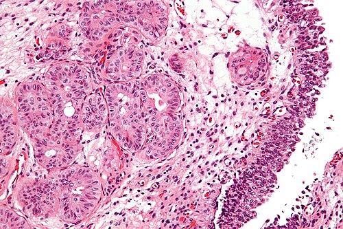 Nested variant of urothelial carcinoma - high mag.jpg