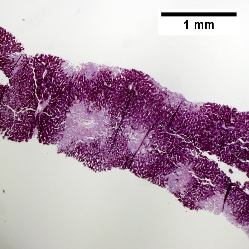 PAS without diastase shows ovoids of necrosis {40X).