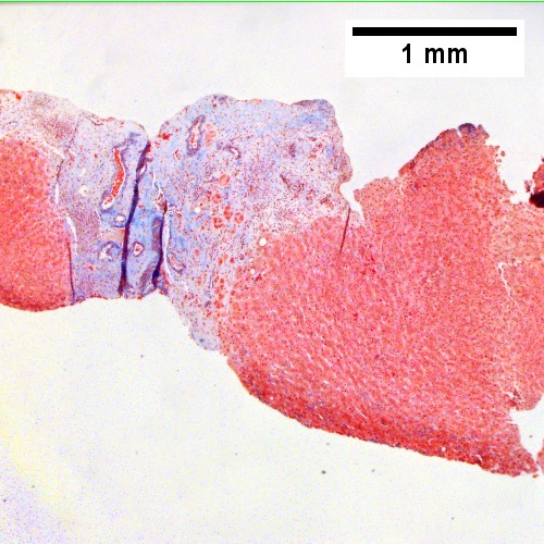 Trichrome shows fibrous scar with vessels/bile ductules (40X)