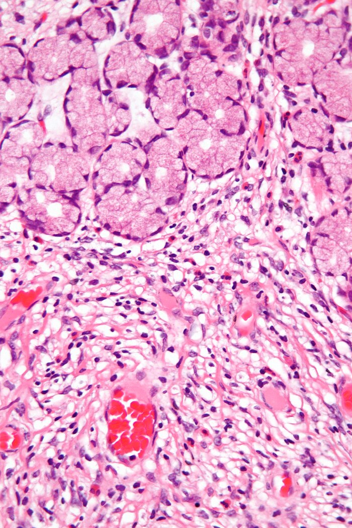 Inflammatory fibroid polyp - very high mag.jpg
