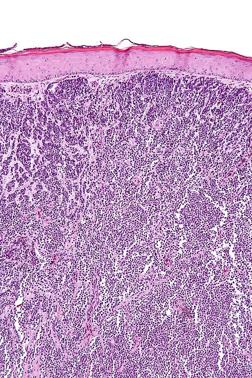 Merkel cell carcinoma - intermed mag.jpg