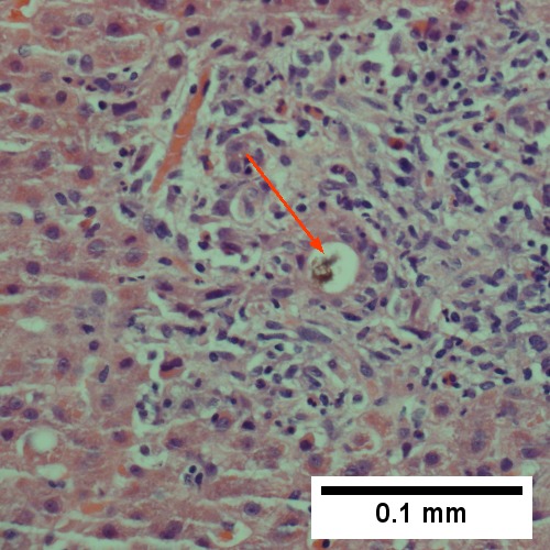 Bile (arrow) in interlobular bile duct with disordered nuclei (400X).
