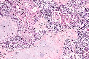 Uterine carcinosarcoma - Libre Pathology