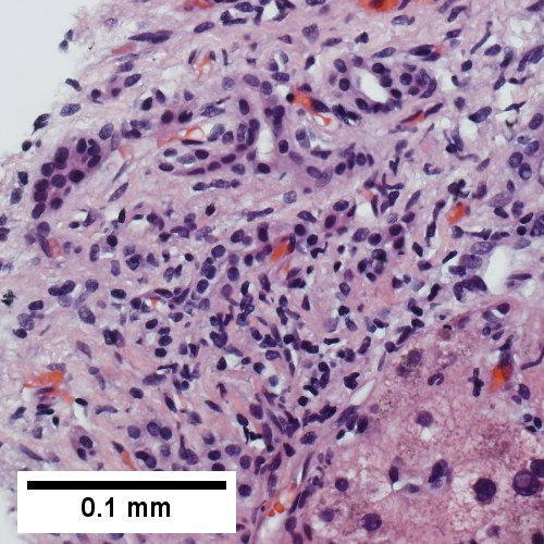At high power, a modest inflammatory infiltrate accompanies proliferating bile ductules; no piecemeal necrosis (400X)