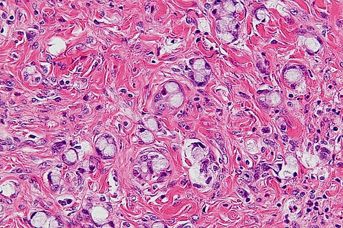 Goblet cell carcinoid -2- very high mag.jpg