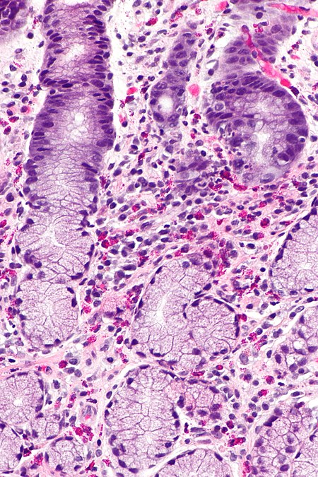 Eosinophilic Gastritis Libre Pathology 