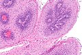 Squamous Papilloma Of The Esophagus Libre Pathology