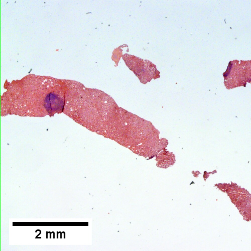 Primary Biliary Cirrhosis Libre Pathology 7723