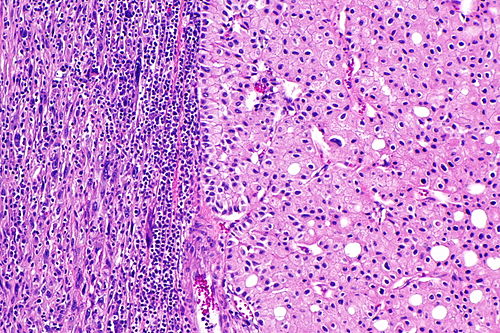 Chromophobe renal cell carcinoma with sarcomatoid differentiation -- intermed mag.jpg
