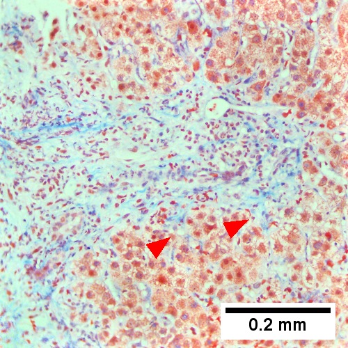 Trichrome stain shows periportal fibrosis [red arrowheads] (200X).