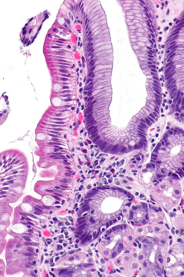 Gastric Heterotopia Of The Duodenum Libre Pathology