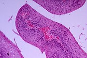 Squamous Papilloma Of The Esophagus Libre Pathology