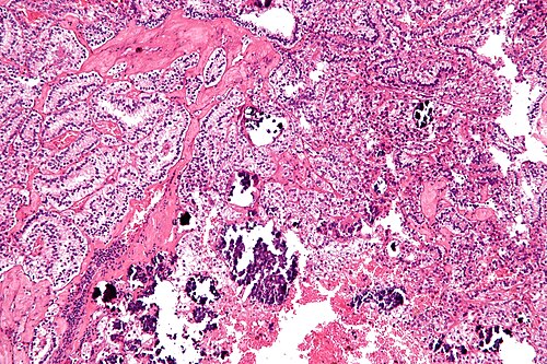 Xp11.2 translocation renal cell carcinoma - intermed mag.jpg
