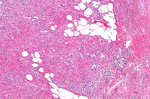 Goblet cell carcinoid -2- intermed mag.jpg