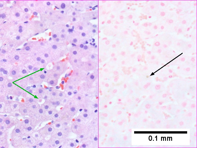 Hemocrhomatosis with DILI canalicular cholestasis with mild hepatocyte injury in the form of regeneration.