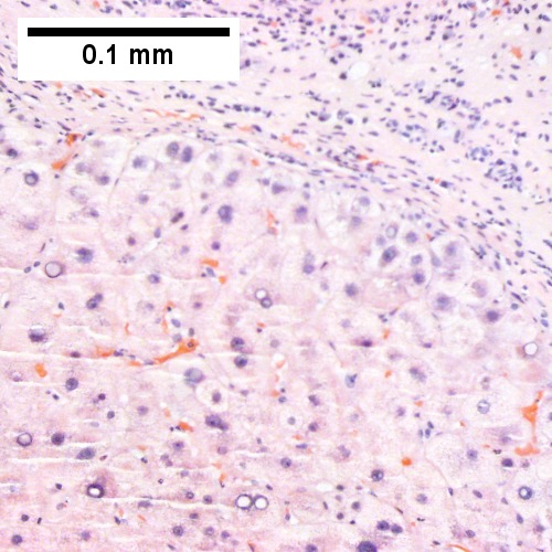 This nodule has occasionally enlarged nuclei, which should not be considered dysplasia in and of itself. Note associated relatively inflammation free band with proliferated bile ductules. (Row 2 Left 400X).