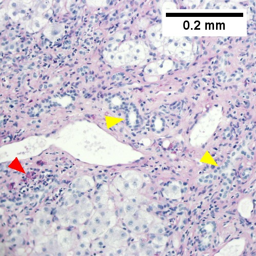 Edematous stroma, proliferating ductules [yellow arrowheads], PAS-D macrophages [red arrowhead] (PAS with diastasse, 200X)